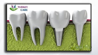 ما هي زراعة الاسنان